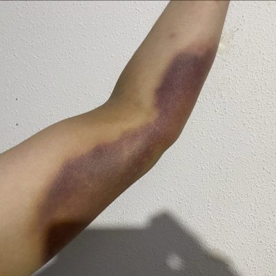 testimonio_margarilab_unguento_hematoma_antes